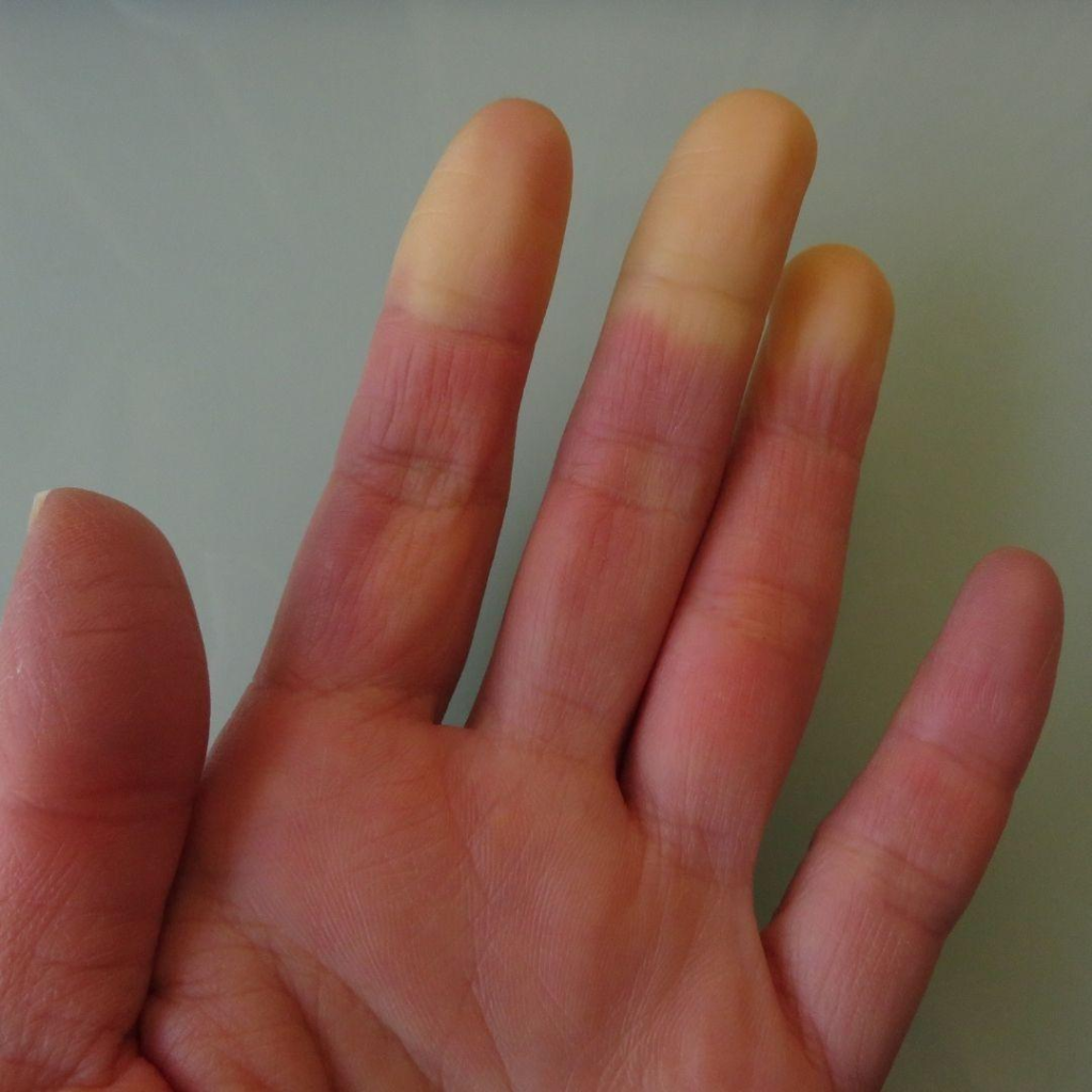 Raynaud’s Phenomenon